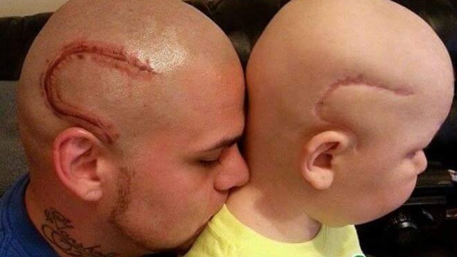 Usa, morto il piccolo Gabe: il suo papà si fece tatuare una cicatrice in testa uguale alla sua