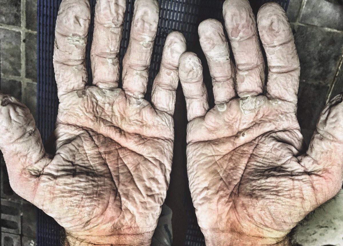 I segni del gelo sulle mani del canottiere olimpico: la foto shock