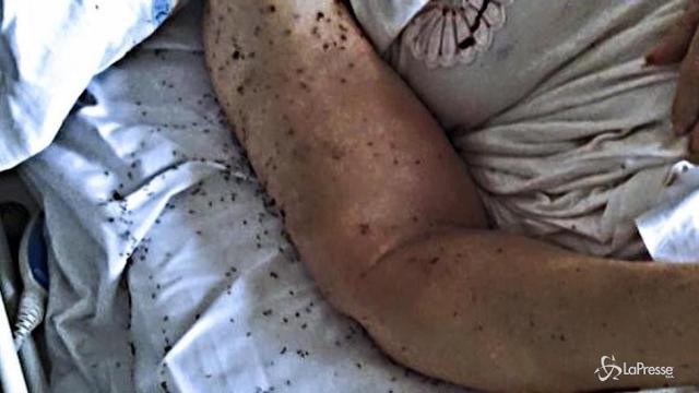 Napoli, formiche in letto d’ospedale: indagini in corso
