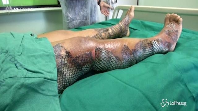 Squame di pesce per curare le ustioni