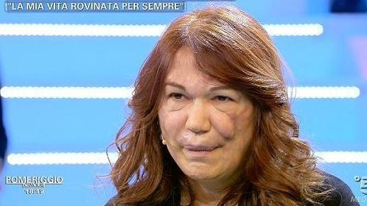 Pomeriggio5, donna sfigurata da chirurgia: Medico mi ha truffata