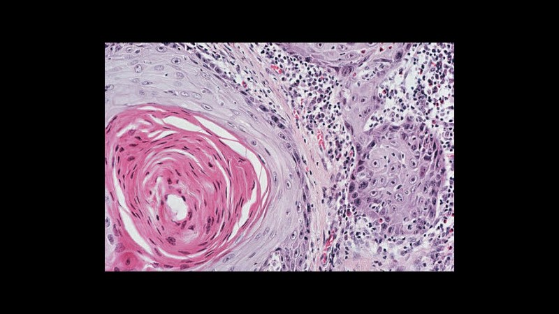 Usa, docente con cancro gira video su suo caso e li carica sul web
