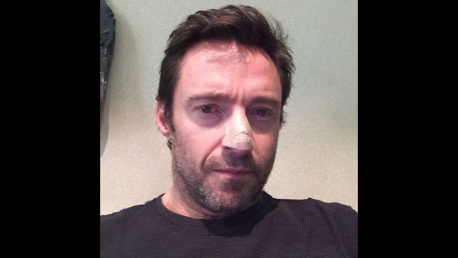 Hugh Jackman operato per un tumore alla pelle