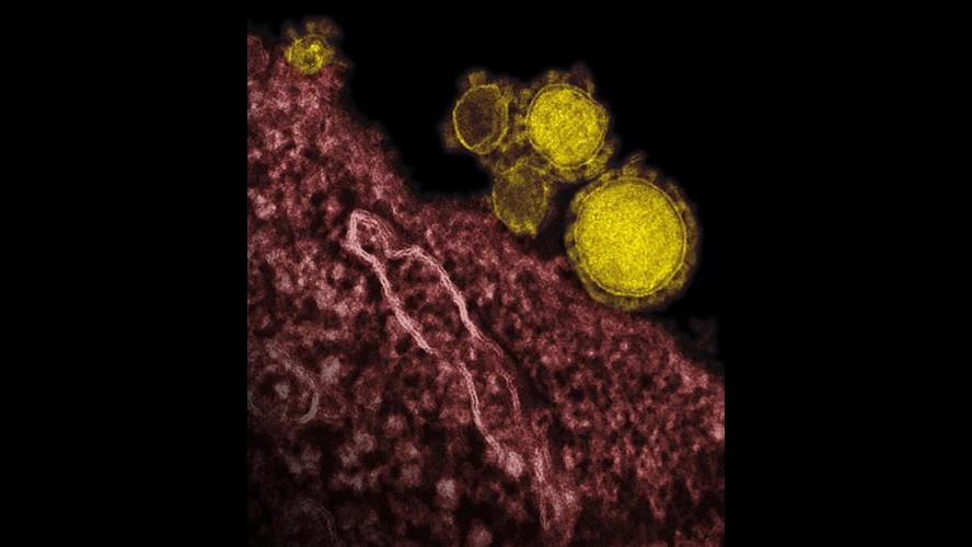Nuova Sars, 1° caso in Spagna: virus contratto in Arabia Saudita