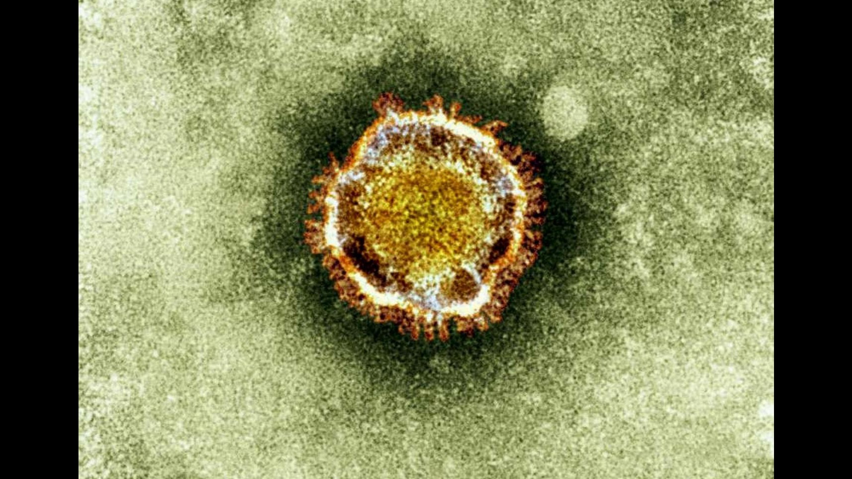 Nuova Sars, primo caso contagio pazienti-medici in Arabia Saudita