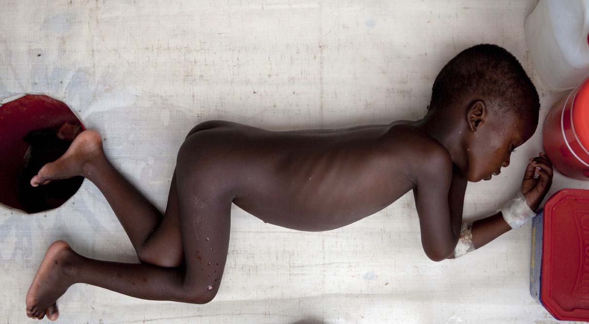Haiti, il colera è una piaga