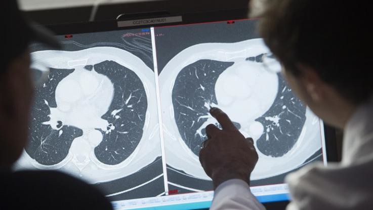 Via libera alla terapia cellulare CAR-T contro linfomi e leucemia Lla