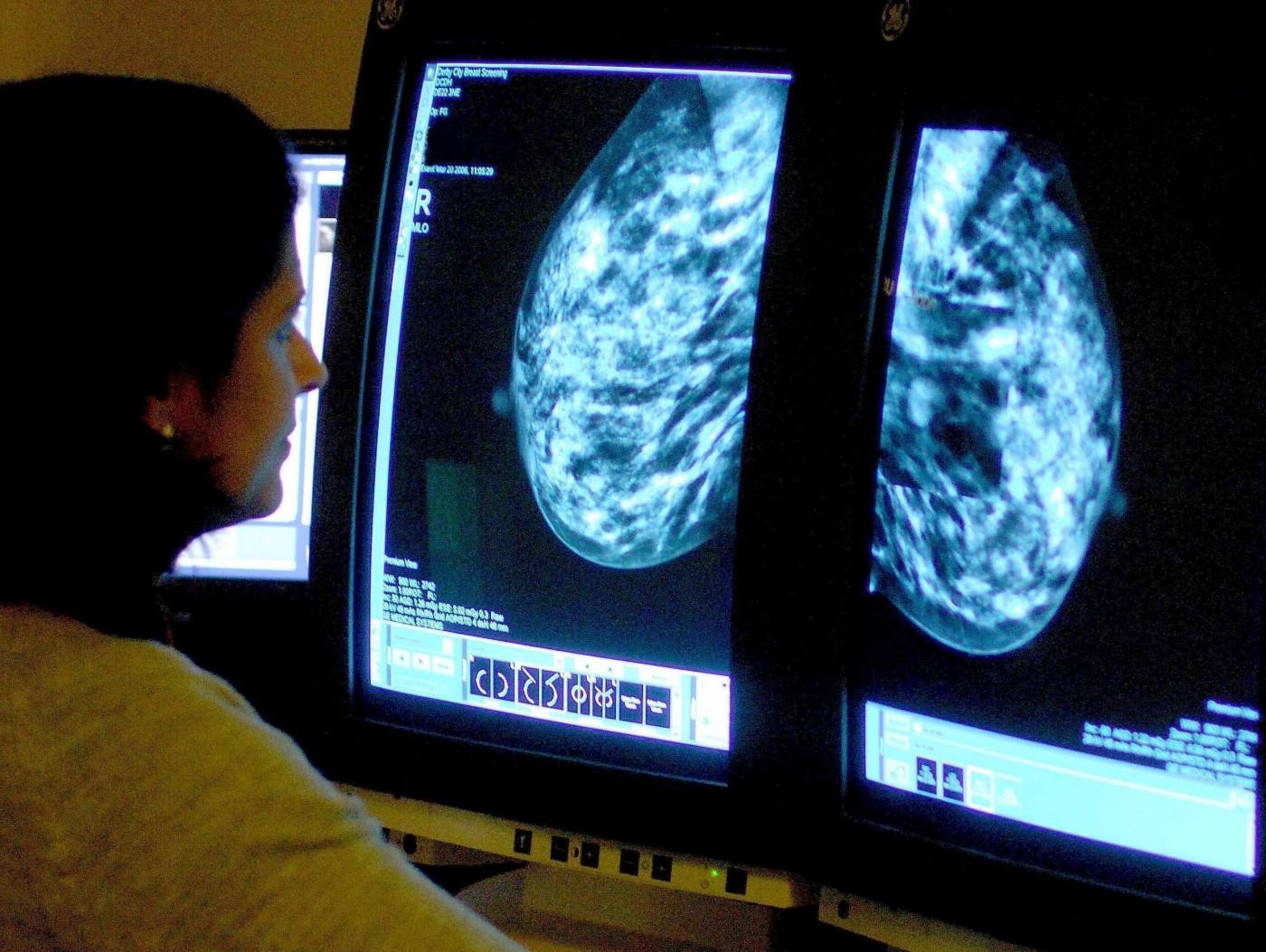 Identificati i geni per predire le metastasi del cancro al seno