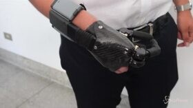 Torino, perde la mano per un petardo: al Cto applicata protesi bionica