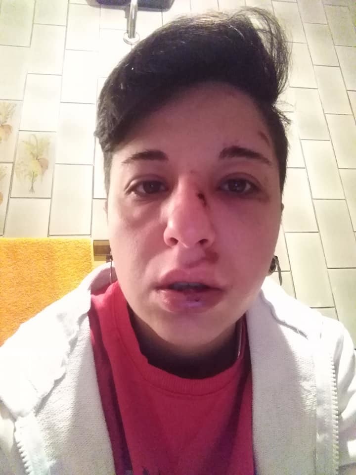 Potenza: picchiata da sconosciuti perché lesbica, la foto-denuncia su Fb