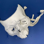 Intervento record a Torino: volto ricostruito d’urgenza in 3D a paziente 23enne