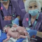 Israele, separate due gemelline siamesi: le immagini dell’intervento