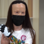 Torino, consegnata protesi bionica a Valentina Pitzalis