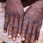 Vaiolo delle scimmie, Ecdc-Oms: “17.800 casi in Europa, il 99% uomini”