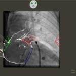 Primo intervento al mondo combinato per fibrillazione atriale a Torino