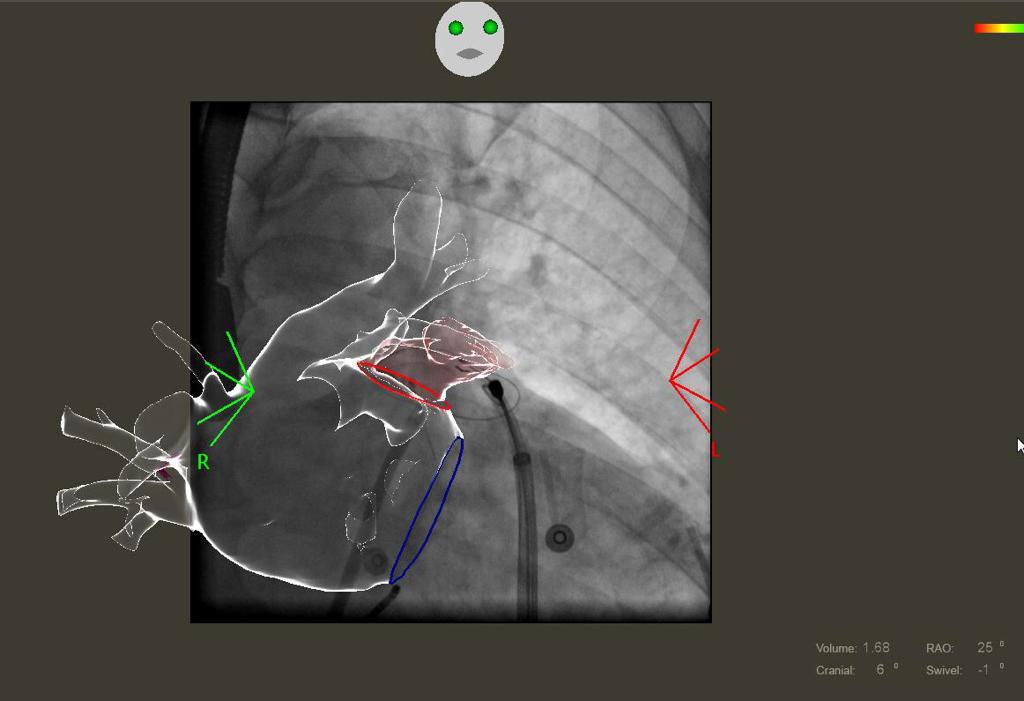 Primo intervento al mondo combinato per fibrillazione atriale a Torino Primo intervento al mondo combinato per fibrillazione atriale a Torino
