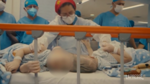Brazil, separated Siamese twins attacked by head: operation lasted 27 hours