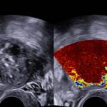 Salute, via i fibromi senza bisturi: a Genova primo intervento con microonde