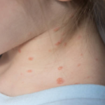 Salute, +3000% casi morbillo in Europa e Asia centrale