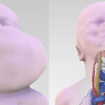 Roma, enorme tumore a gola: operato alla nascita da équipe Bambino Gesù