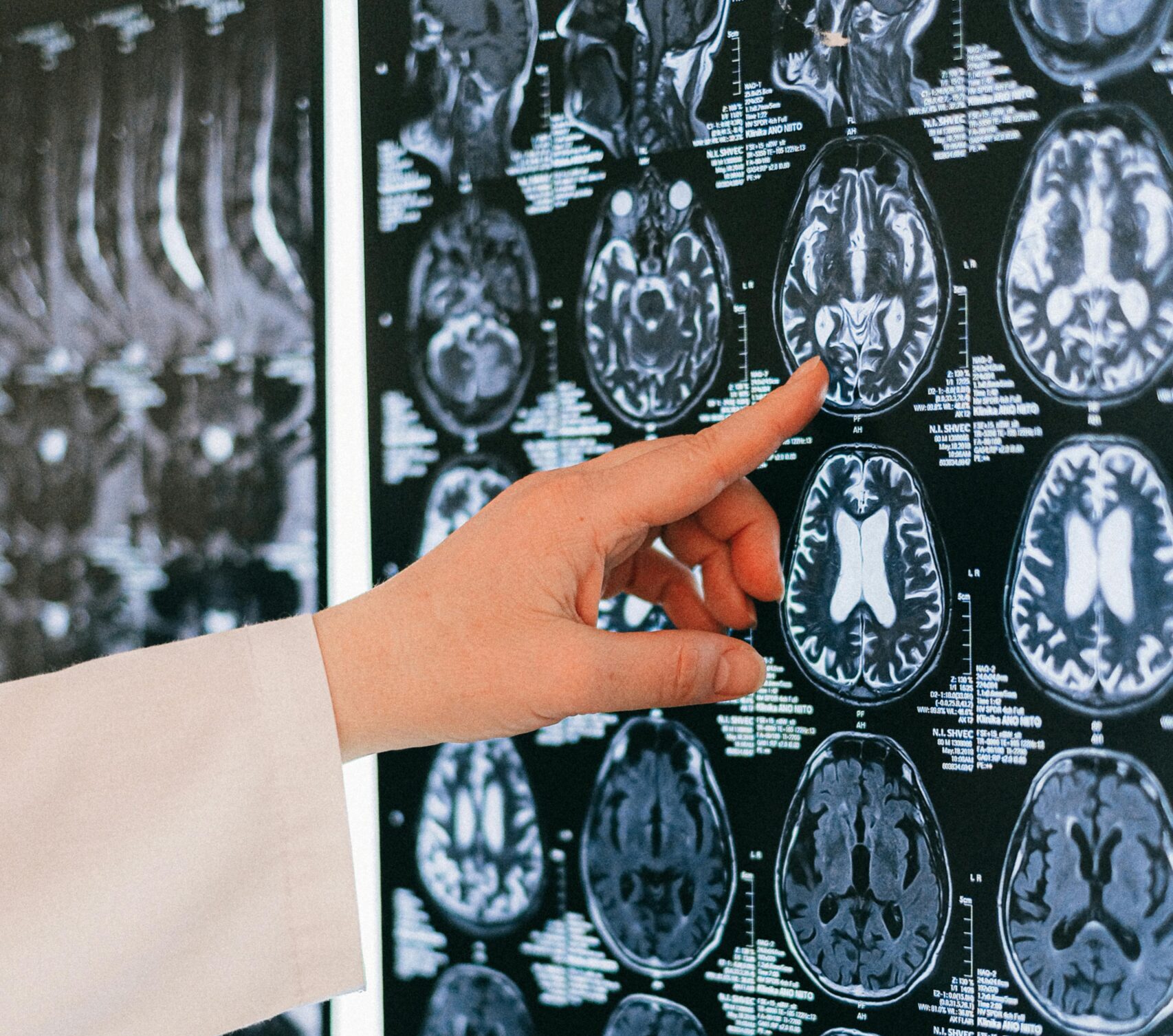 Salute mentale, identificata area cerebrale che inibisce paura e ansia