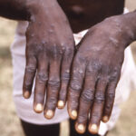 Vaiolo delle scimmie dichiarato emergenza sanitaria mondiale dall’Oms