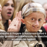 Che cos’è la progeria, la malattia di cui era affetto Sammy Basso