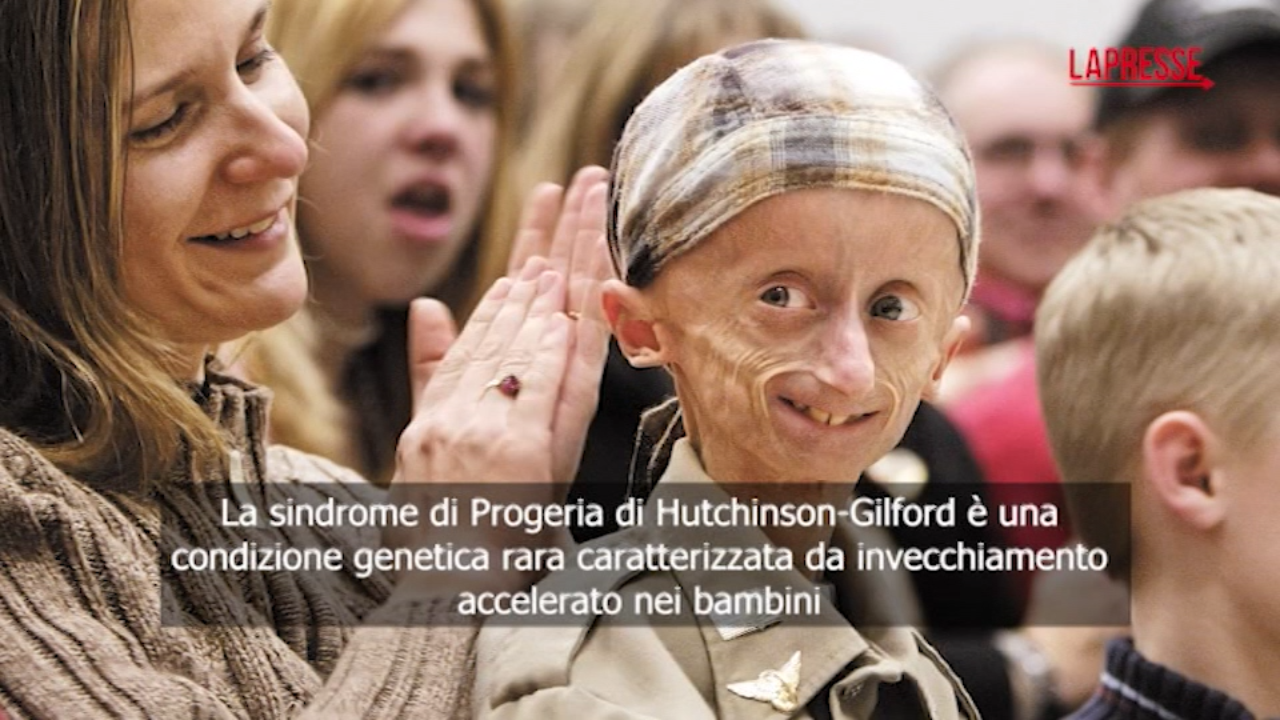 Che cos’è la progeria, la malattia di cui era affetto Sammy Basso