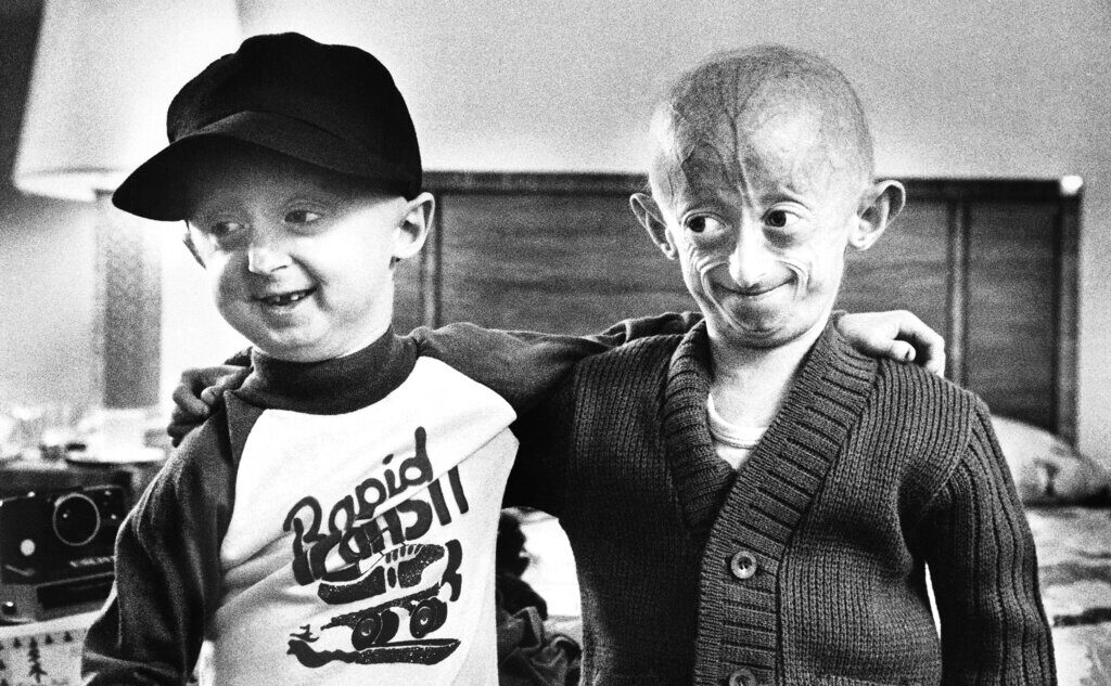 Progeria cos’è da Lapresse