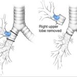 Torino, 16enne con raro tumore ai polmoni salvato da intervento super innovativo