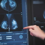 Tumore al seno, Humanitas introduce l’Intelligenza Artificiale per la diagnosi precoce