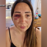 Gaia, brutalmente picchiata dal suo ex a Pozzuoli: “Sono una sopravvissuta”