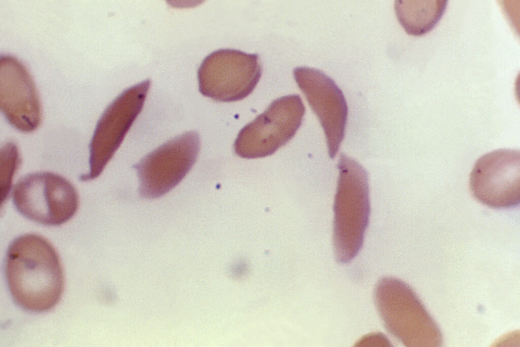 Leucemia mieloide acuta, cos’è la malattia di Polonara e sintomi Leucemia mieloide acuta, cos’è la malattia di Polonara e sintomi