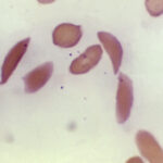 Leucemia mieloide, cos’è la malattia di Polonara e sintomi