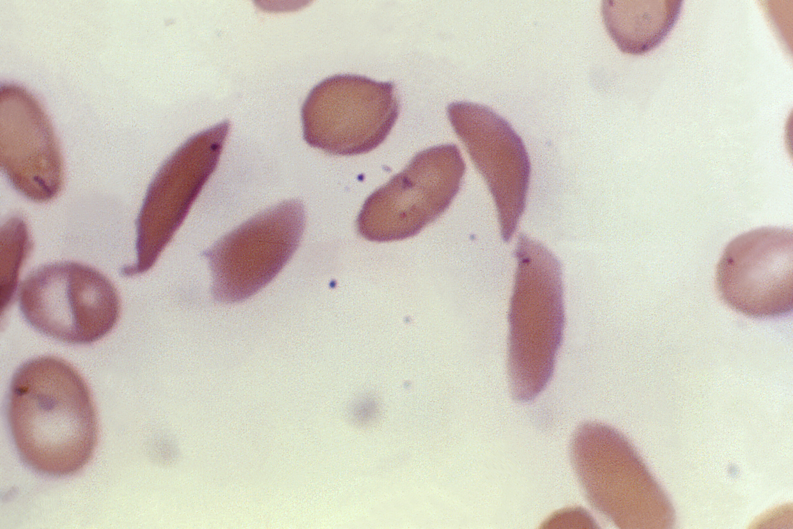 Leucemia mieloide acuta