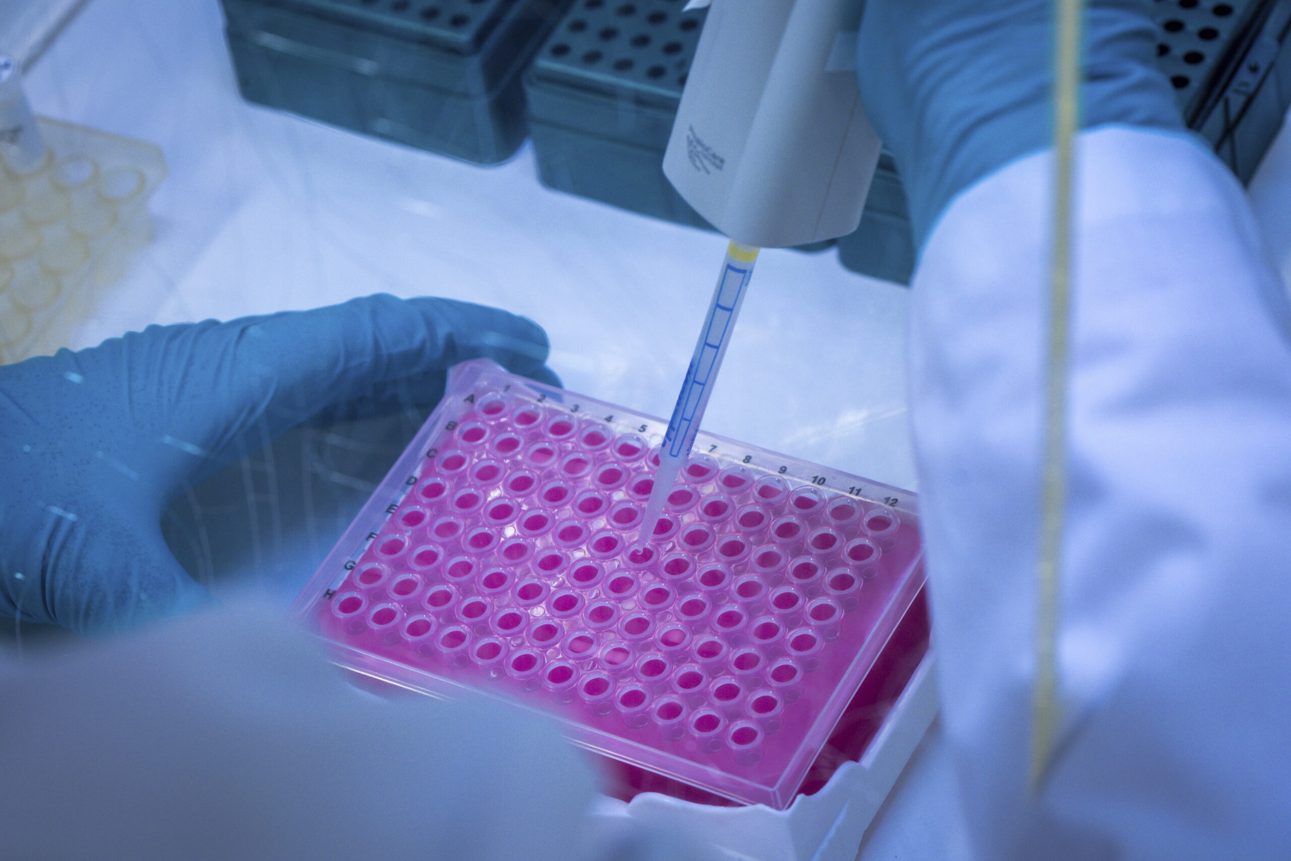 Tumori del sangue, scoperta la variante genetica che riduce il rischio