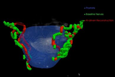 Tumore di rene e prostata, ecco come l’AI rivoluziona la chirurgia oncologica