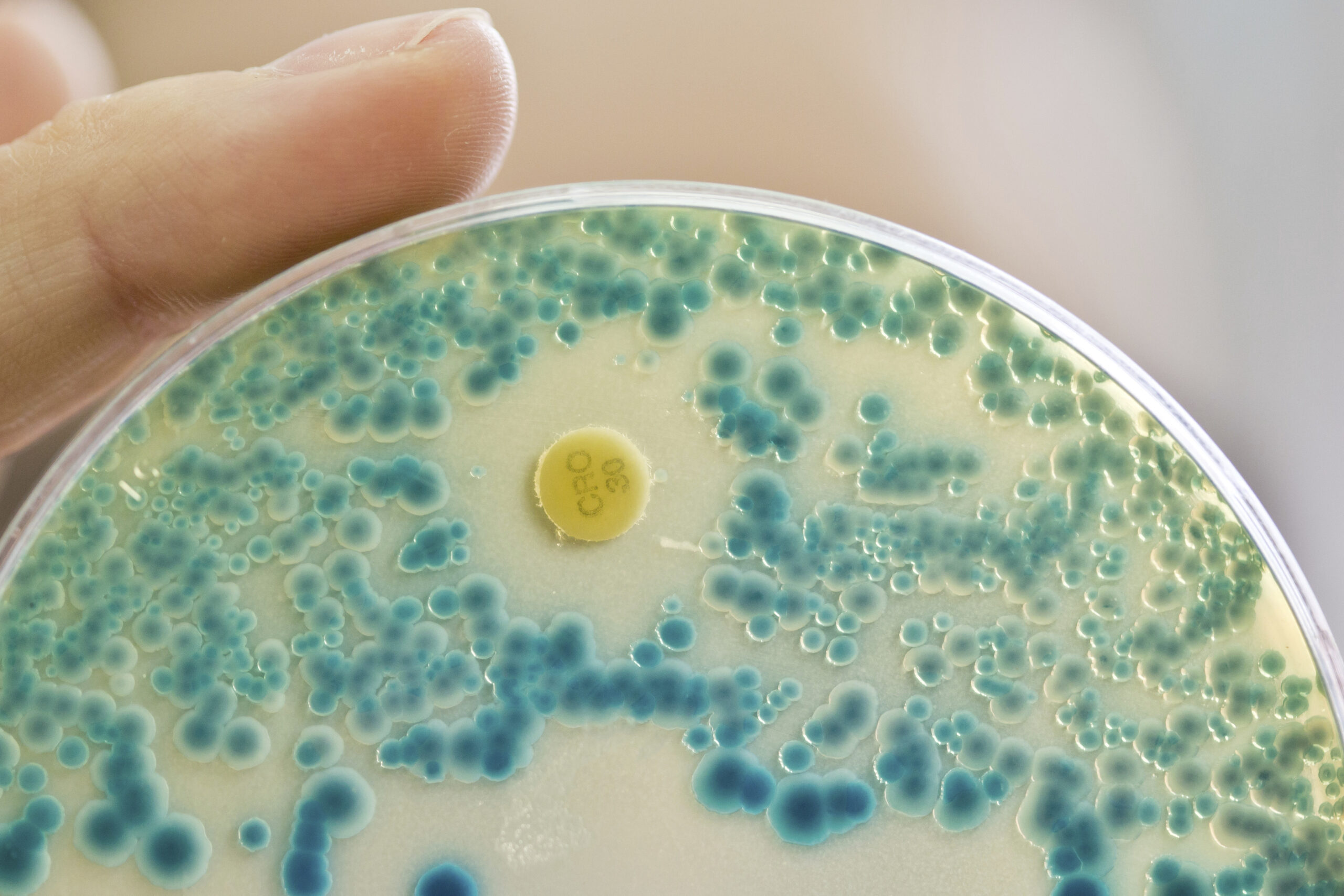 Che cos’è la meningite tubercolare che ha colpito la bimba ricoverata a Bologna