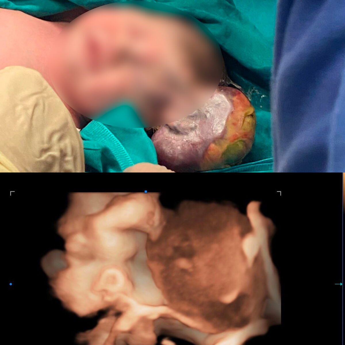 Medicina di precisione e malformazioni dei neonati, la storia di Anna