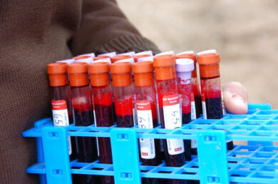 Colesterolo: anticorpo monoclonale riduce del 31% il rischio di infarto o ictus 