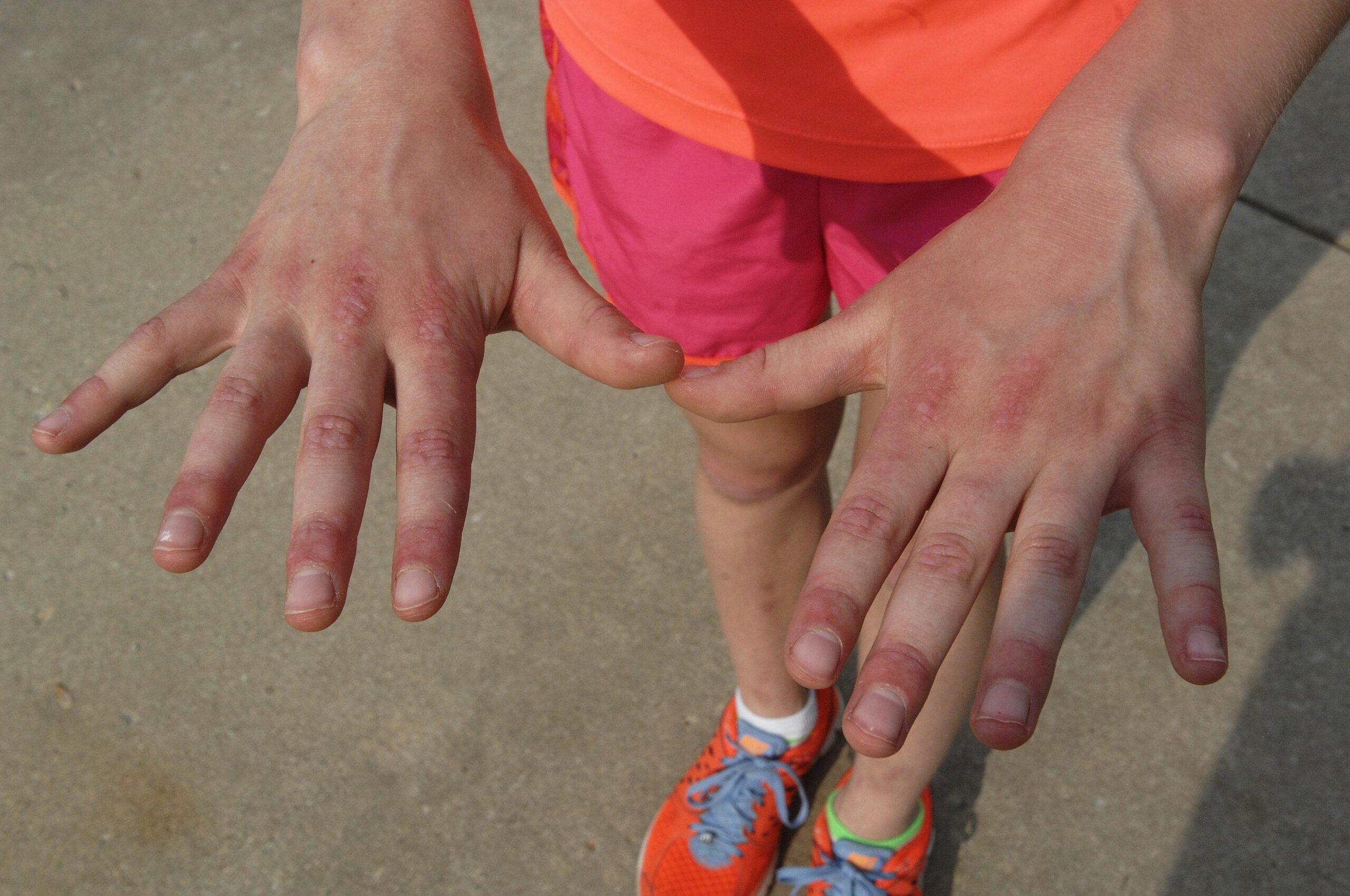 Orticaria cronica spontanea, i costi e l’impatto sulla vita quotidiana