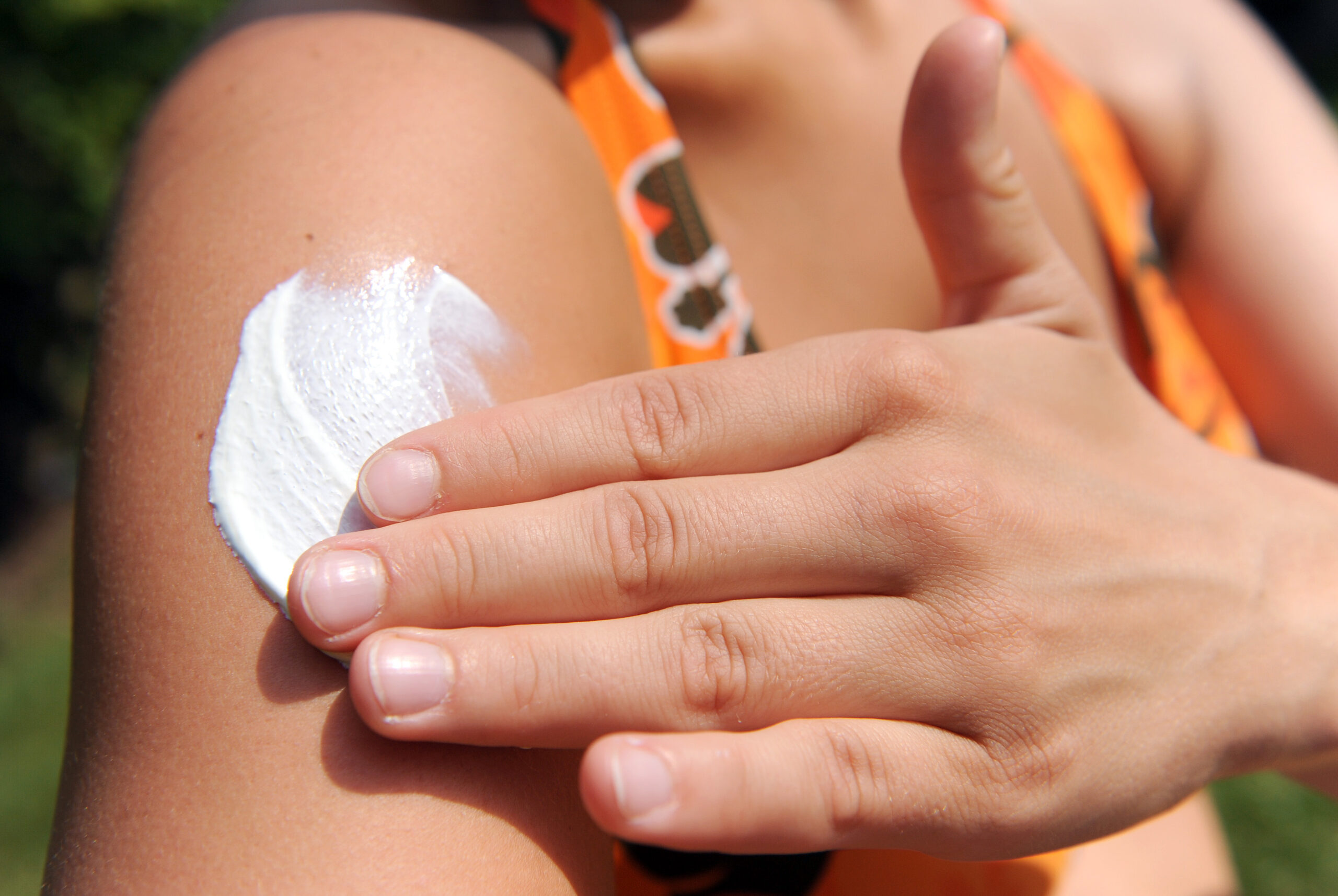 Scottature, colpi di sole e disidratazione: come prevenire le insidie dell’estate