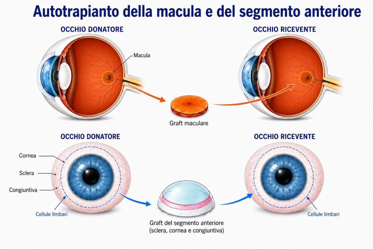 Torino, trapianto da occhio a occhio e la paziente torna a vedere: è la prima volta al mondo