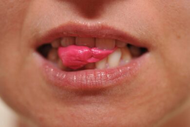 La gomma che riduce Hpv e batteri dei tumori testa-collo: lo studio in laboratorio